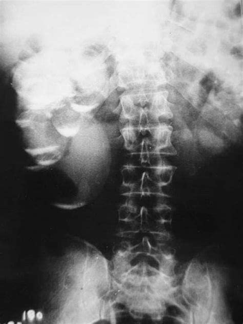 FINAL DIAGNOSIS Renal milk of calcium cyst. | Kidney cyst, Cysts, Renal