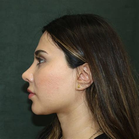 Before After Rhinoplasty In Beverly Hills Ca Dr Harris