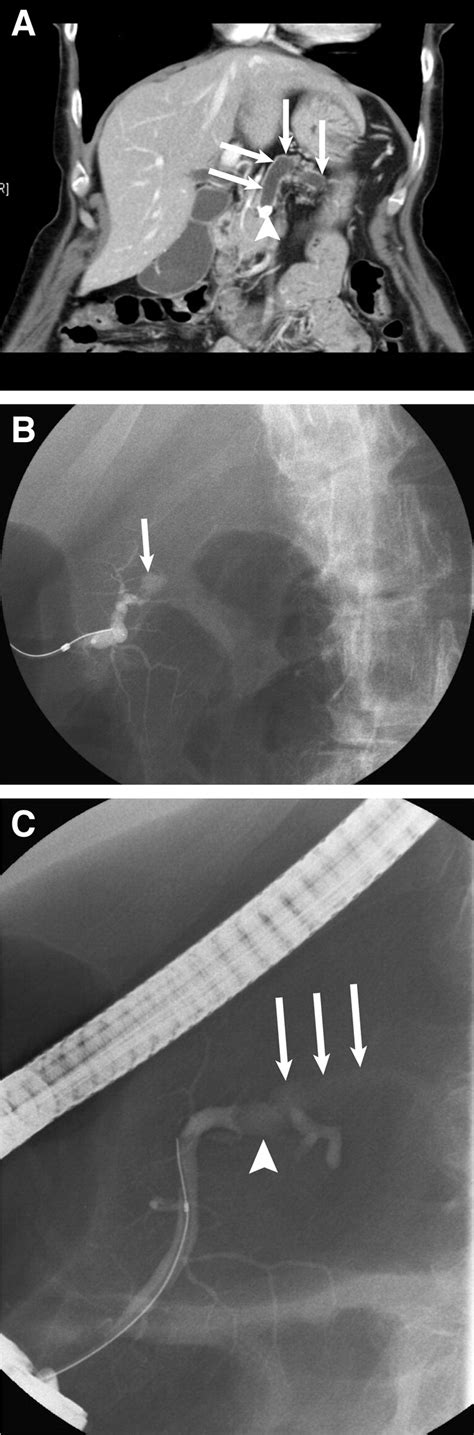 References In Endoscopic Retrograde Pancreatography Clinical