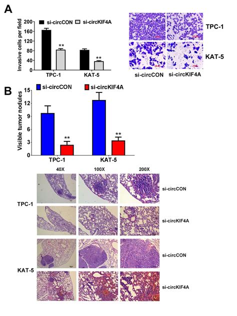 Downregulation Of Circkif4a Suppresses The Metastasis Of Papillary