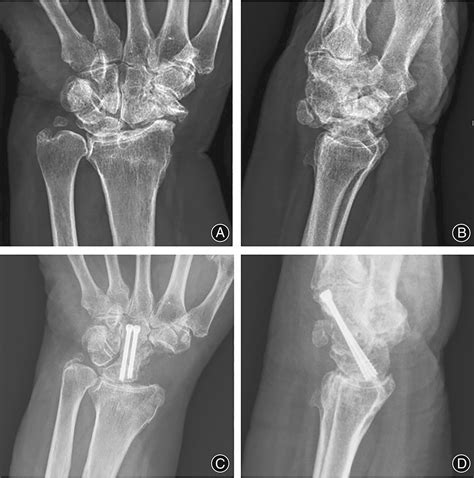 Lateral Approach For Scaphoid Excision And Capitolunate Arthrodesis In