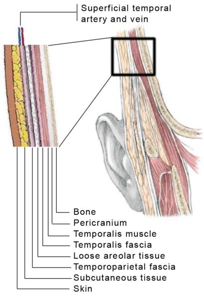 Anatomic Layers Of The Temporal Region Note That Superficial Temporal