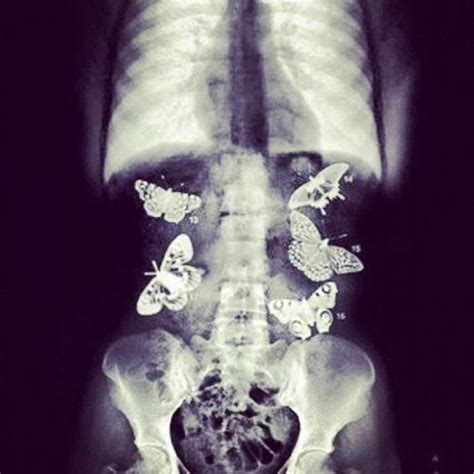 Butterflies In Stomach Xray Butterflies In My Stomach Butterflies