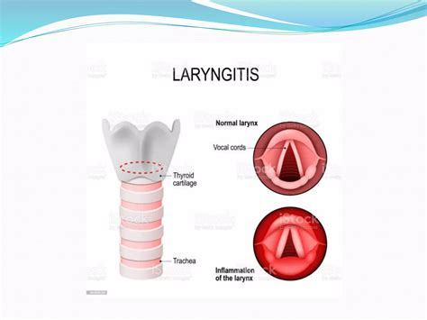 Laryngitis Pptx