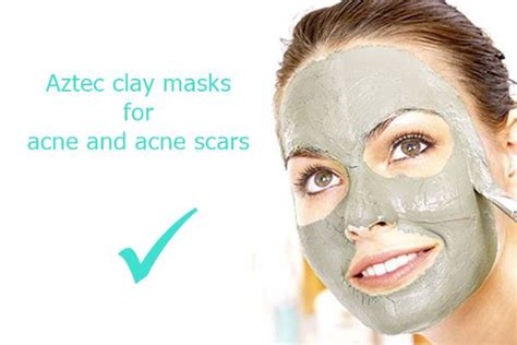 Aztec Healing Clay Mask for Acne | Mask Natural