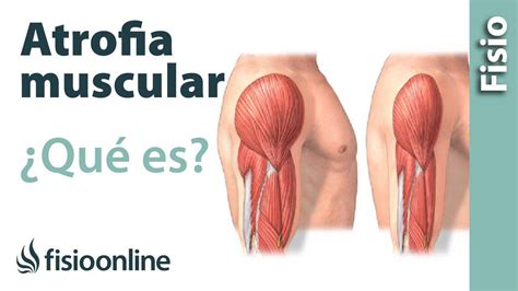 ¿Qué es la atrofia muscular? Cuales son sus causas y tratamiento | FisioOnline