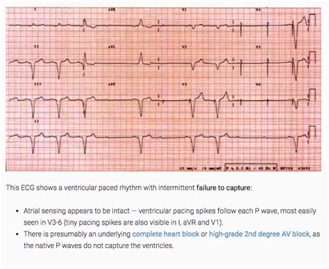 Pacemaker Malfunction — Maimonides Emergency Medicine Residency