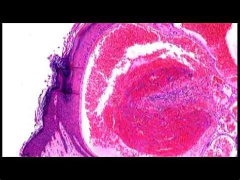 Pathology Of Angiokeratoma By Dr Sampurna Roy MD In 2022 Pathology