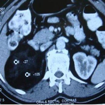 Coronal section CT scan of right sided adrenal myelolipoma. | Download ...