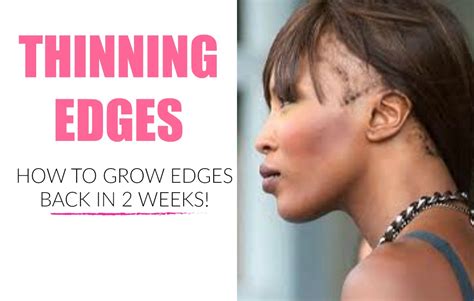 Get Practical Tips To Regrow Your Thinning Edges Fast