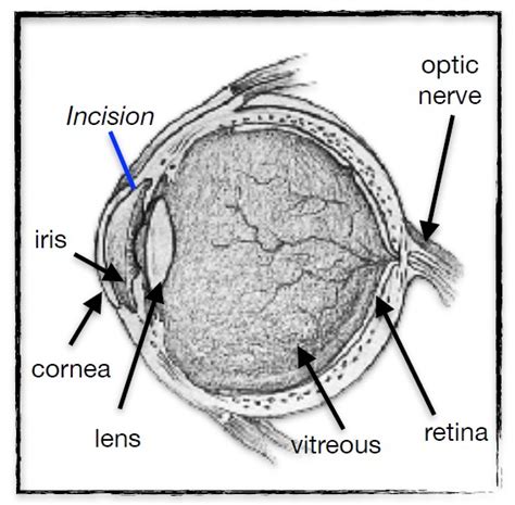 Cataracts The Sight Surgery