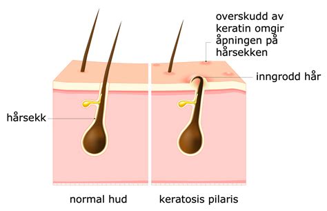 Keratosis Pilaris Store Medisinske Leksikon