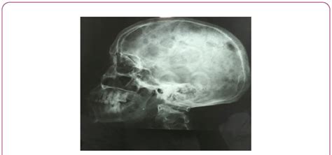 Lateral Skull View Showed Multiple Punched Out Lesions Over Frontal Download Scientific Diagram