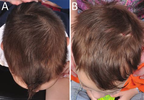 Case 1 Pre A And Postoperative B Photographs Of The Patient