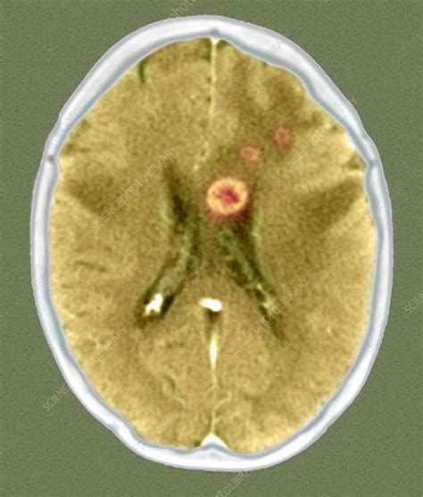 Secondary Brain Cancers Ct Scan Stock Image M134 0509 Science