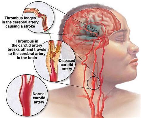 Carotid artery disease - Stenosis, Carotid Artery Dissection