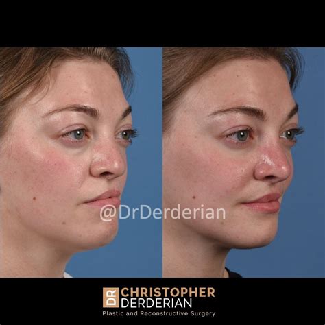 Cleft Rhinoplasty — Dr Derderian — Plastic And Reconstructive Surgery