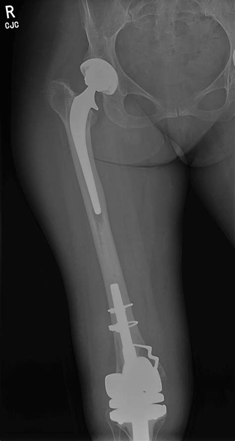 Preoperative Anteroposterior X Rays Of The Patient Showing The Total Download Scientific