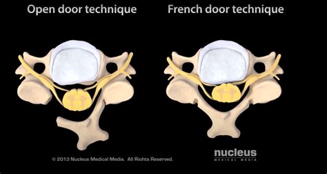 Cervical Laminoplasty Definition Spine Info