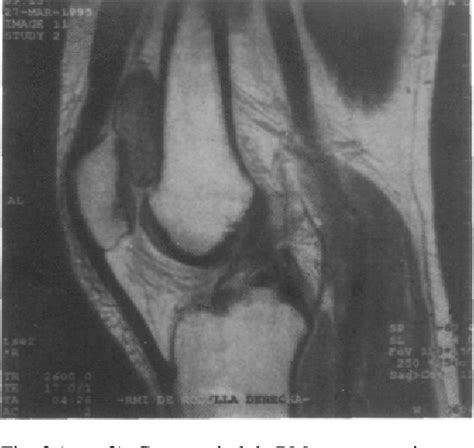 Figure From Sinovitis Vellonodular Pigmentada Localizada De Rodilla