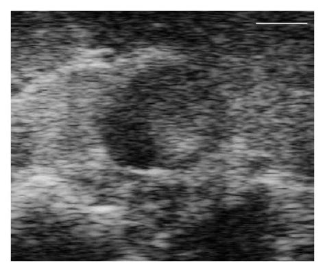 Gross Dissection Of Aaas Shows Shape Of Aaas Detected By B Mode Images Download Scientific