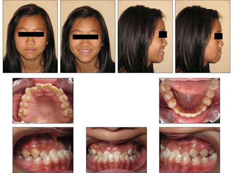 Class Iii Malocclusion Treatment Options Gertude Sauls