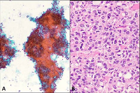 A And B Papillary Thyroid Carcinoma Solid Variant A The Tumor