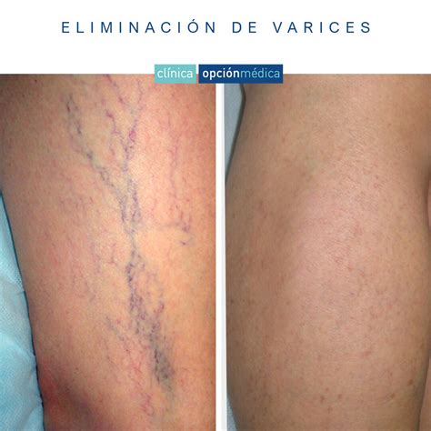 Tratamiento Natural Para Las Varices En Las Piernas Descubre Efectivas