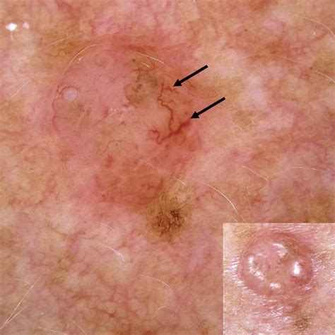 Basal Cell Carcinoma And Balloon Cell Nevus Collision Mimicking A