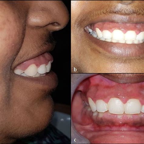 A Markings Of The Depth Of Gingival Sulcus With Krane Kaplan Pocket