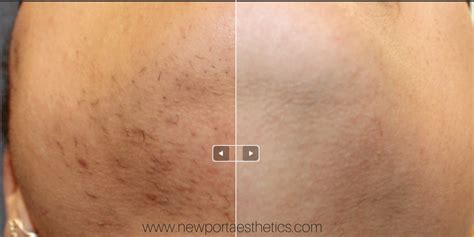 Laser Hair Removal Newport Aesthetics