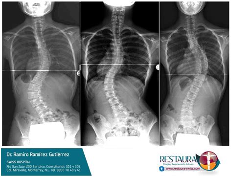 DrColumna ESCOLIOSIS