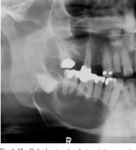 Figure From Keratocystic Odontogenic Tumor A Recurrence Analysis Of