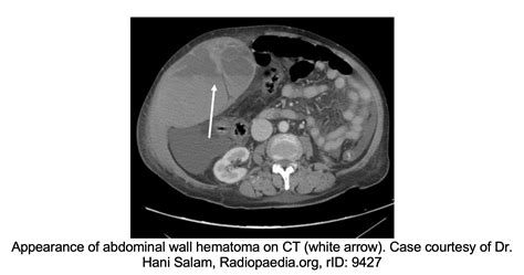 emDOCs.net – Emergency Medicine EducationCholecystectomy Complications ...