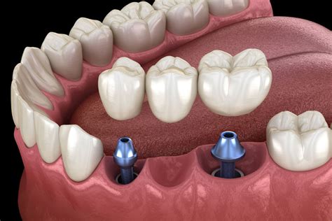 Dental Implants Louisville Florence Ky Embrace Dental Care