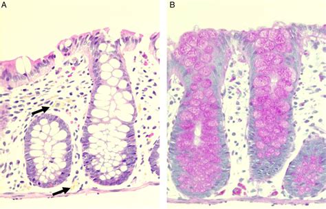 Histopathological Features Of Patients With Chronic Granulomatous Disease