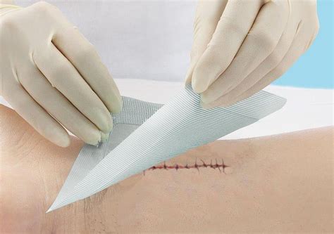 Incision Care and the Prevention of Surgical Site Infections - Medline