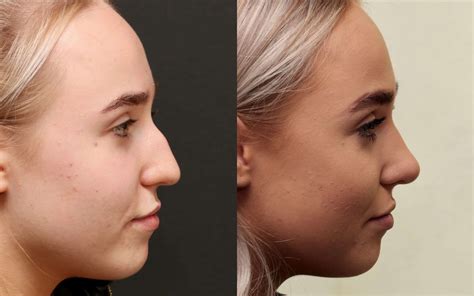 Plastic Surgery Before And After Nose Jobs