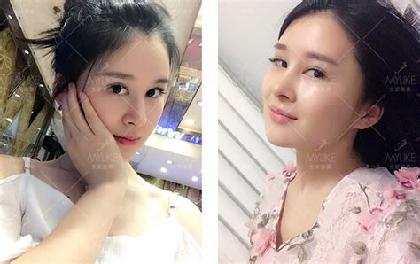 Monica鼻综合整形效果图隆鼻前后对比照片上海美莱整形医院