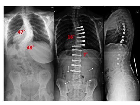 Non Fusion Corrective Scoliosis Surgery An Tâm