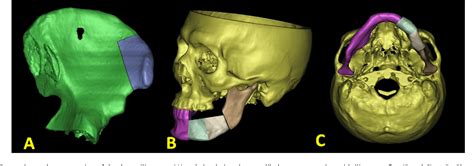 Figure 2 From Improving The Accuracy Of Mandibular Reconstruction With Vascularized Iliac Crest