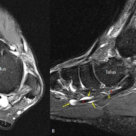 The hyperplantarflexion test consists of forcing the foot into maximal ...