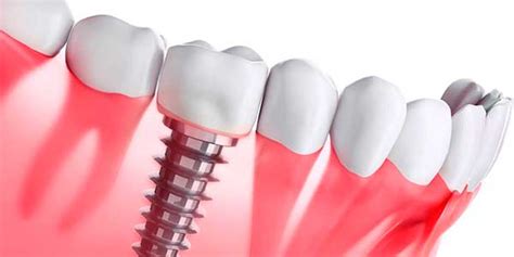 Implantes Dentales Todo Lo Que Necesitas Saber