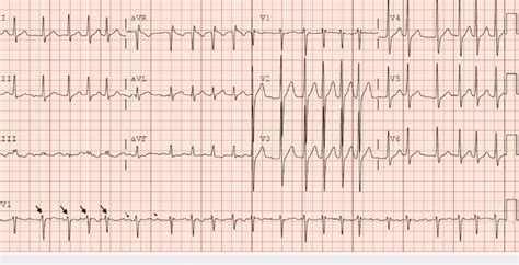 A Lead Electrocardiogram Showing Atrial Fibrillation With A Pulse