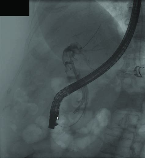 A Cholangiogram Demonstrated Multiple Filling Defects Consistent With