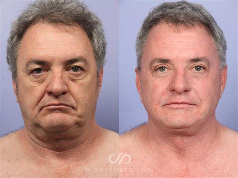 Before And After Plastic Surgery Men