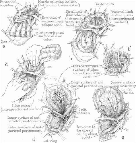 Figure 1 From Sliding Indirect Inguinal Hernia Semantic Scholar