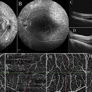 Multimodal Imaging Of The First Case A And B Show The Fundus Photo