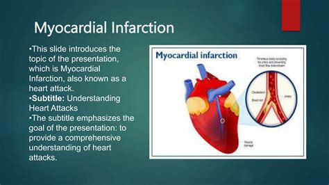 Understanding Myocardial Infarction Pathophysiology Diagnosis And