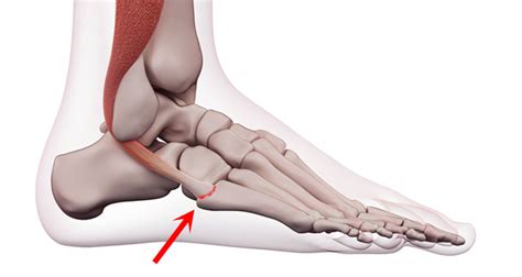 Peroneal Tendon Tear Symptoms Causes Treatment Exercises